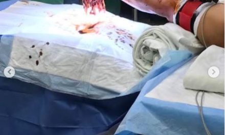 Imágenes fuertes. El pulgar seguía intacto milagrosamente, hombre pierde la mano con picadora industrial