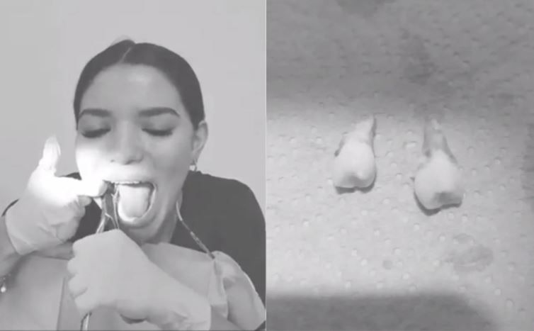 ¡Se extrae sola las muelas del juicio!; habilidosa dentista se vuelve viral (video)