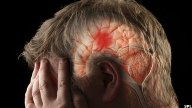 Reconoce un derrame cerebral