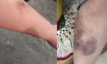 Viral: Ataca personal de un bar a joven en Saltillo; ella reporta a 911 y policía la discrimina (Fotos)