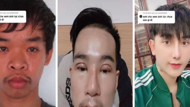 Viral: No conseguía trabajo por feo, se hizo 9 cirugías y ahora es un famoso Tiktokero