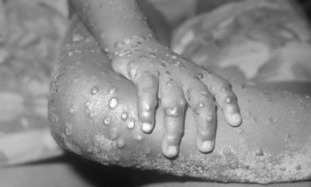 Bélgica es el primer país en deccretar cuarentena por ‘viruela del mono’