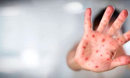 Suben a 18 los casos de viruela del mono en Jalisco; aumentaron cinco en una semana