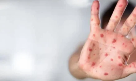 Advierten por ‘la gripe del tomate’, nueva enfermedad que afecta a niños menores de 5 años