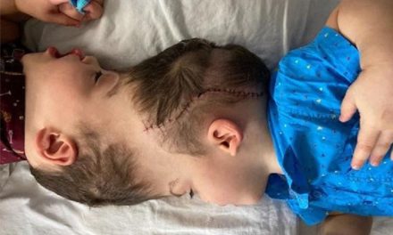 Así fue la separación de siameses con cerebros fusionados en Brasil (video)