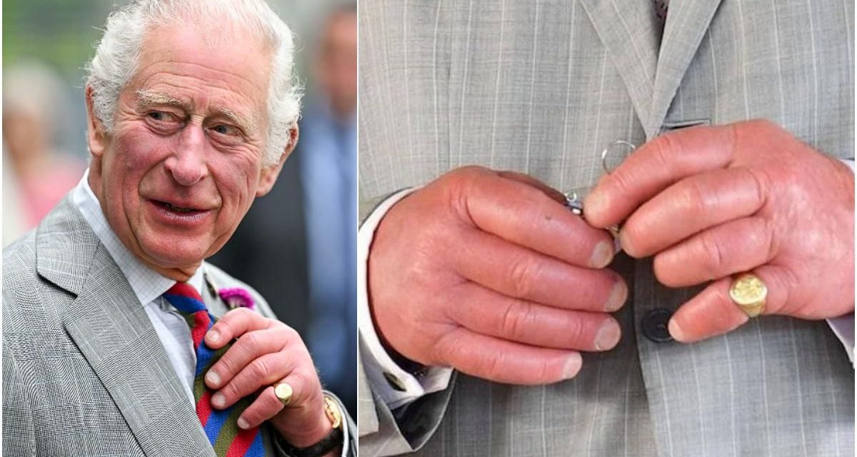 La razón por la que el rey Carlos III tiene ‘dedos de salchicha’