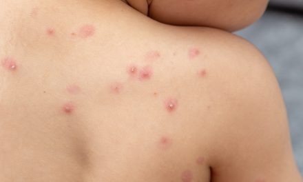 Hay 30 estados con casos de viruela del mono; México supera los mil contagios