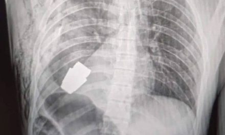 Someten a cirugía a soldado ucraniano para quitarle granada activa del torso