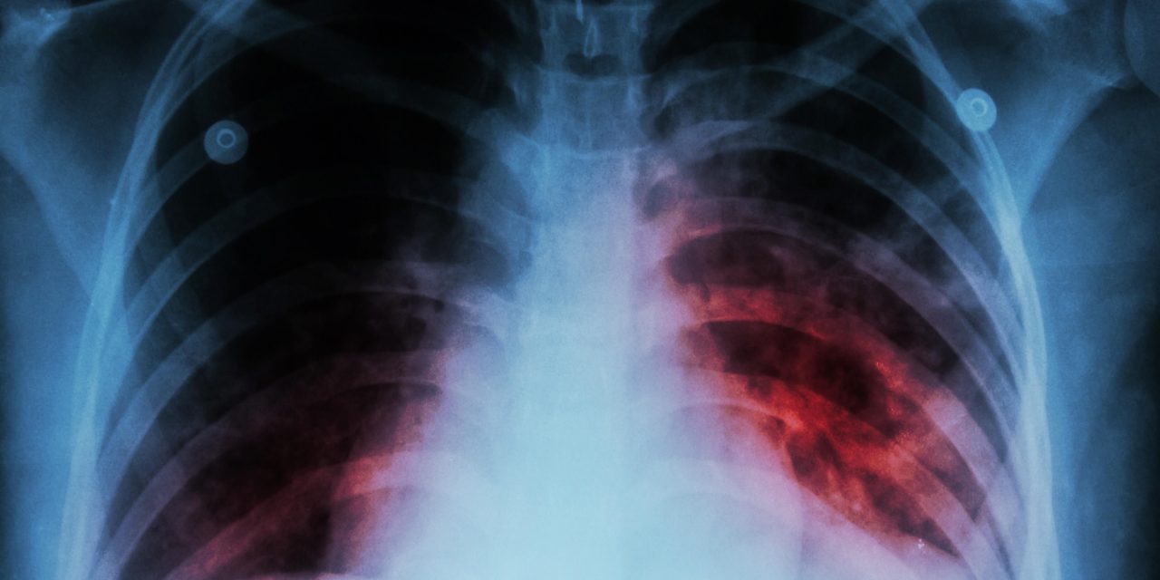 Volvieron los casos de tuberculosis a Coahuila