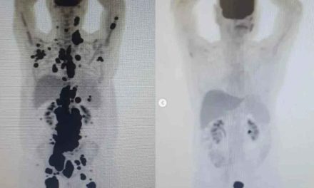 Hombre revierte cáncer en un mes con innovador tratamiento