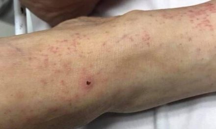 Rickettsia termina con una familia de San Pedro