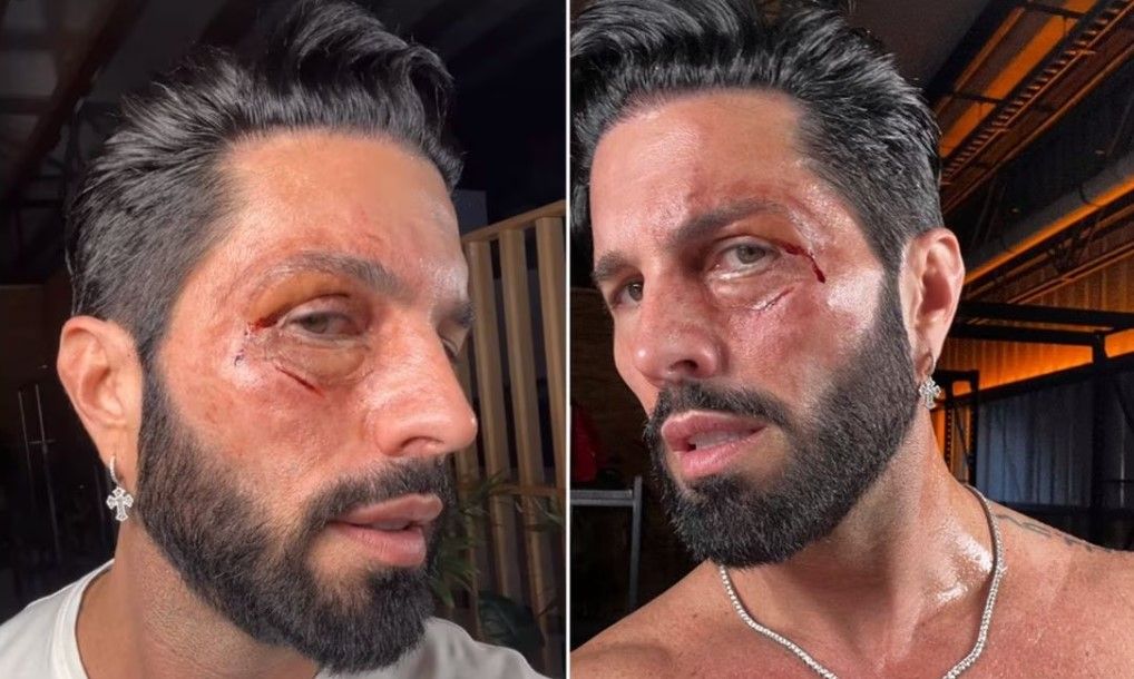 ¿Qué le pasó a Poncho de Nigris en su rostro?