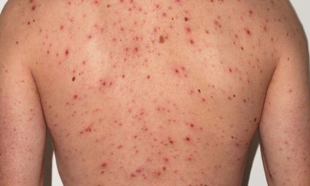 Emiten alerta sanitaria por casos importados de sarampión en México
