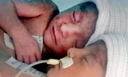 Gemelas siamesas, originarias de Saltillo fueron separadas en el Materno Infantil de Monterrey