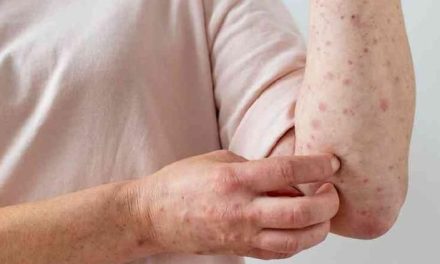 Hasta el momento van 53 casos de mpox en México donde la mayoría son hombres