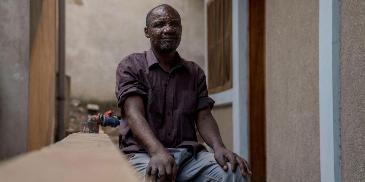 Africa registra más de 18,900 casos y 540 decesos por mpox o viruela del mono