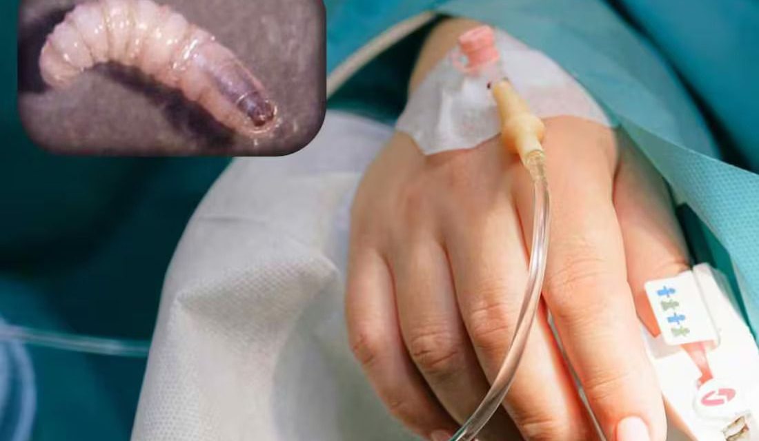 Reportan primer caso de gusano barrenador en humano en Yucatán