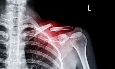 IA acelera detección de fracturas en hospitales de Irlanda del Norte