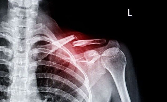 IA acelera detección de fracturas en hospitales de Irlanda del Norte