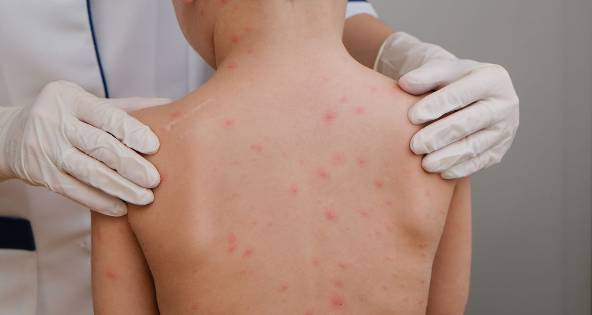 Se mantiene activa la alerta por sarampión en México