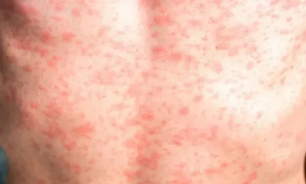 Alerta sanitaria en Nuevo León: Confirman 24 casos de sarampión